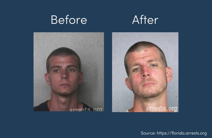 faces of addiction showing person before and after fentanyl abuse