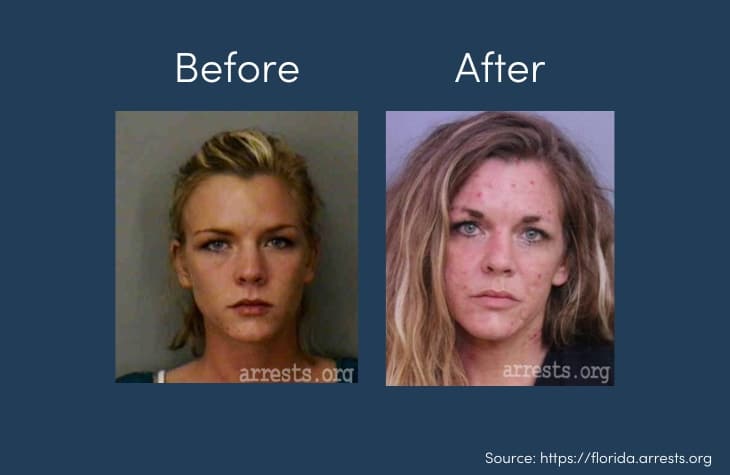 faces of addiction showing person before and after meth abuse