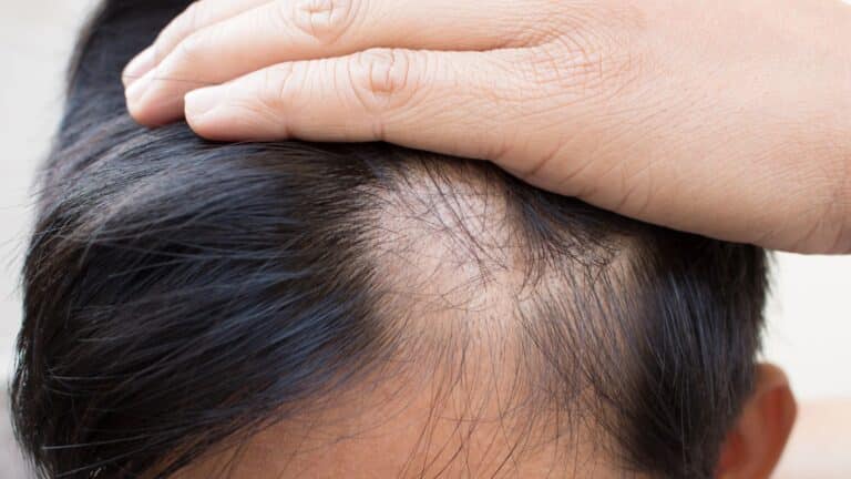 guy having hair loss